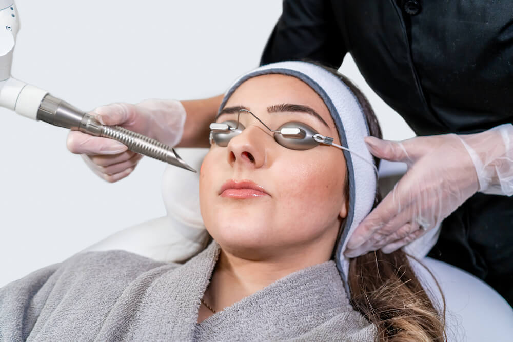 Benefits of IPL Photofacial Over Traditional Facials
