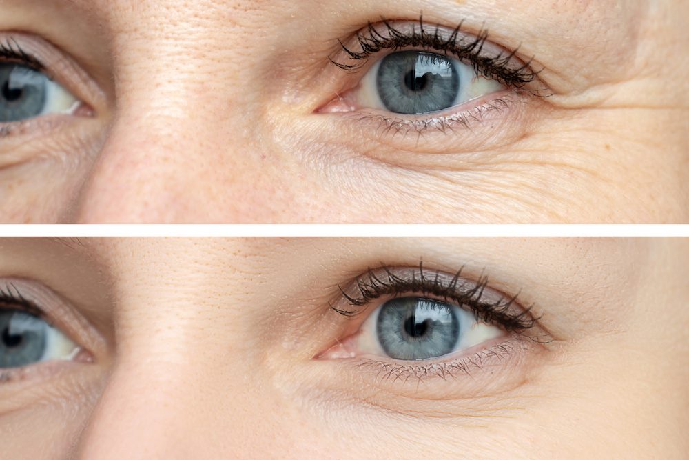 woman before and after a botox touch up session in los angeles